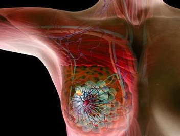 NK細胞免疫療法，讓“乳腺癌”細胞無處可逃
