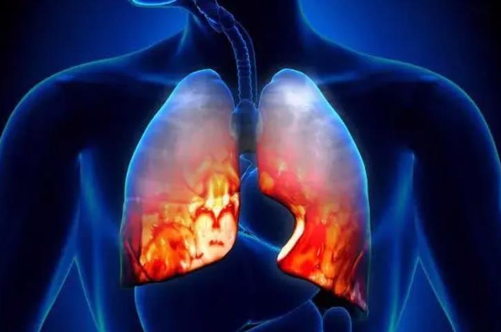 干細胞與間質性肺疾病